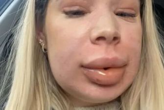 Женщина чуть не умерла после того, как растворила филлер в губах – фото