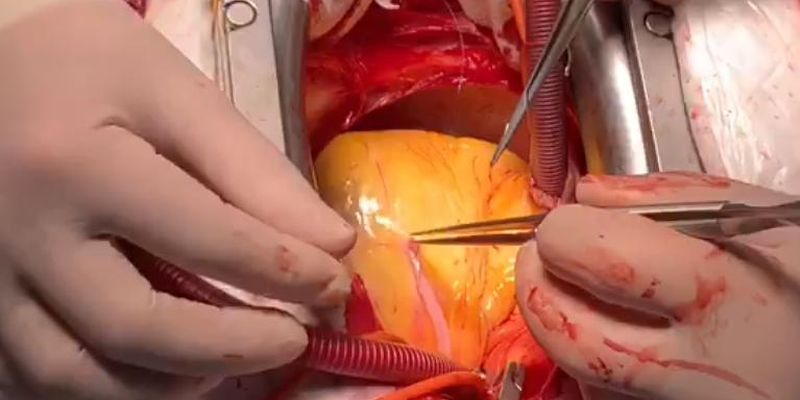 Хірург показав на відео операцію на серці
