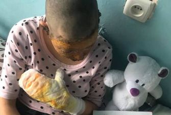 Терпит адские боли: в Черновцах пьяный отец поджег 16-летнюю дочь и едва не угробил ее. Фото 18+