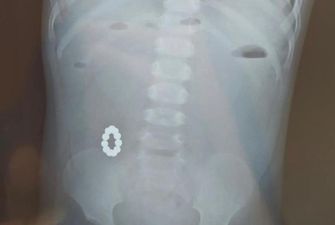 У Харкові однорічна дитина проковтнула 11 магнітів: хірурги дістали з'єднане кільце