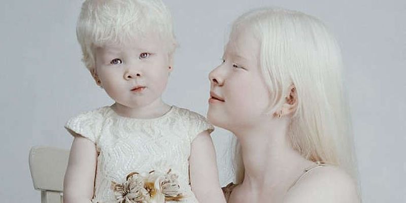 Сестры-альбиносы завораживают сеть своими фотографиями