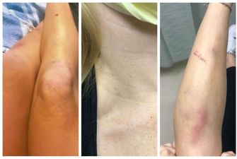 У женщины диагностировали страшную болезнь после того, как она заметила крошечные точки на коже