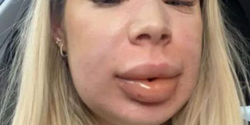 Жінка ледь не померла після того, як розчинила філер у губах – фото