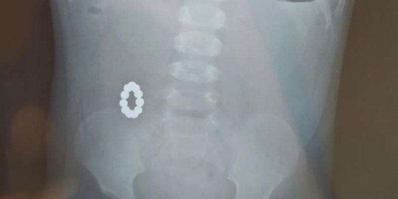 У Харкові однорічна дитина проковтнула 11 магнітів: хірурги дістали з'єднане кільце