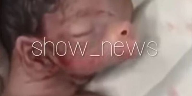 Ребенок с ушами на шее и свиным пятаком родился в Азербайджане: видео 18+