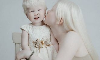Сестри із альбінізмом зачарували світ своєю красою: захопливі фото, які вразять кожного