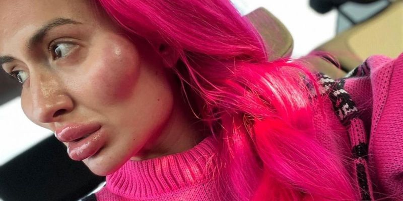 "Дуже шкода обличчя": українка з величезними вилицями показала себе без макіяжу