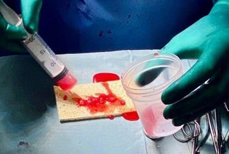 Во Львове впервые провели трансплантацию стволовых клеток