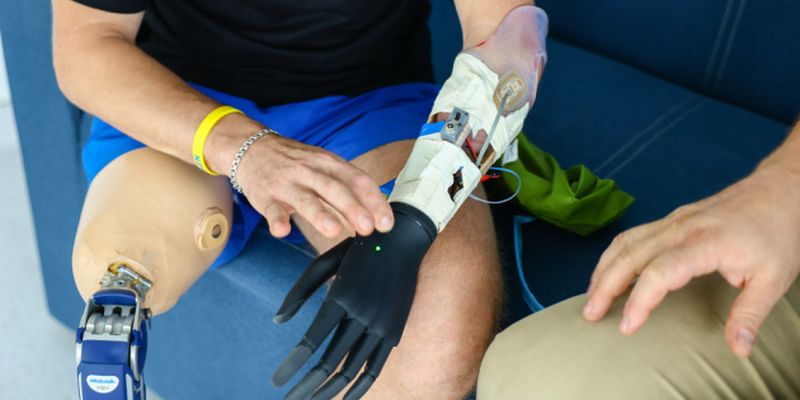 Во Львове установили первый бионический протез руки