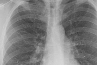 В Украине количество выявленных случаев туберкулеза сократилось на 30%