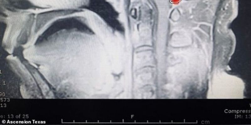 У чоловіка 10 років у мозку жив глист: фото та відео