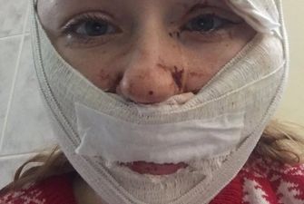 У Туреччині чоловік-ревнивець порізав обличчя 27-річній українці
