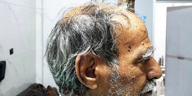 Диагноз "Рог дьявола": в Индии мужчине в ходе операции удалили 10-сантиметровый рог