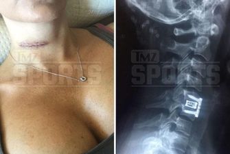 Титанові пластини та гвинти: побита російським боксером Ковальовим американка перенесла 4 операції