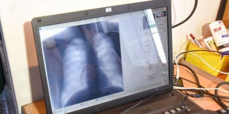 Туберкульоз щороку вбиває 4 тисячі українців