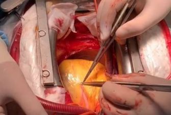 На видео попали кадры, как хирурги делают уникальную операцию на сердце