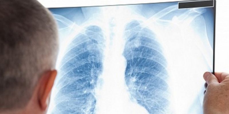 Ежегодно 4 тысячи украинцев умирают от туберкулеза
