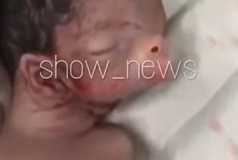 Ребенок с ушами на шее и свиным пятаком родился в Азербайджане: видео 18+