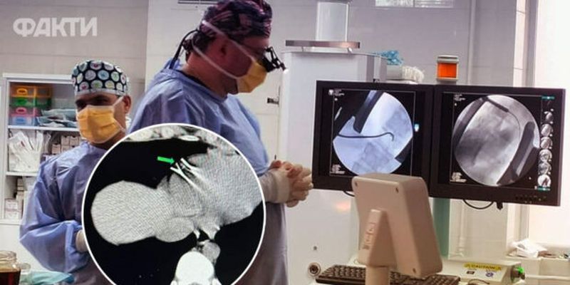 Два металлических осколка в сердце: в Виннице хирурги провели уникальную операцию 22-летнему юноше