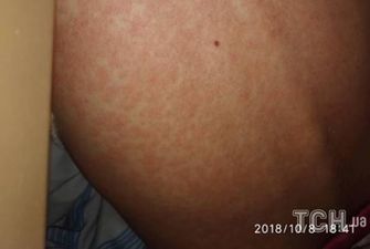 В Україні протягом тижня на кір захворіли майже 70 людей