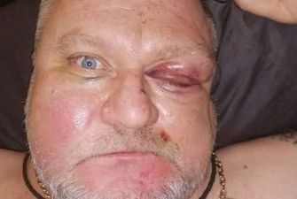 В Херсоне после замечания о петардах избили местного депутата
