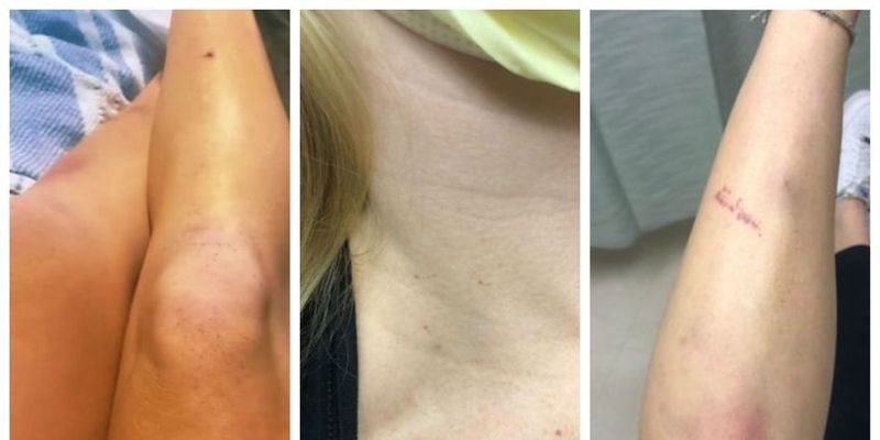 У женщины диагностировали страшную болезнь после того, как она заметила крошечные точки на коже