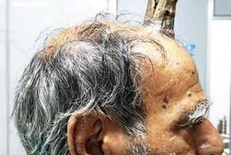 В Индии у мужчины 5 лет рос "дьявольский рог": фото